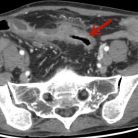 Contrast-enhanced CT image of the pelvis demonstrates a narrowing segment of the distal ileum. There is abnormal bowel wall t