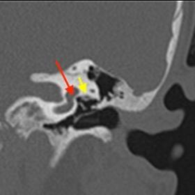 Coronal Temporal Bone CT (Left). Atretic oval window on the left side (red arrow). Tympanic segment of the facial nerve is we