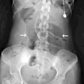 Plain abdominal radiography showing dilated small bowel loops (arrows) in mid-abdomen suggestive of mechanical intestinal obs