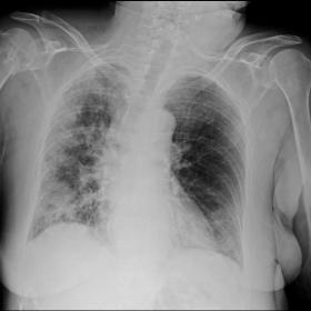 AP chest X-Ray: a reticular-nodular pattern in both lungs, mostly in the right one, was observed. In addition, mild opacities