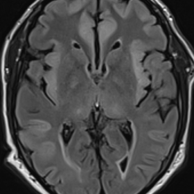 Axial T2-FLAIR image of the brain shows demarcated symmetrical swelling and oedema of the insular cortex, cingulate gyrus and