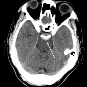 Non-contrast head CT showing acute subarachnoid haemorrhage (white arrow) in the perimesencephalic cisterns with extension to