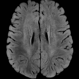 FLAIR and T2 images showed relatively mild symmetric bilateral hyperintensity of the deep and periventricular white matter al