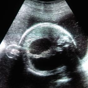 Double bubble sign on a transverse view of fetal abdomen