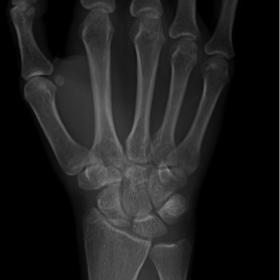 Wrist radiograph reveals a correct alignment of carpal bones, with no clear sign of fracture lines.