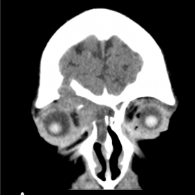 Mucocele showing extension along the medial orbital floor and right frontal sinus. The lesion is isodense to brain parenchyma