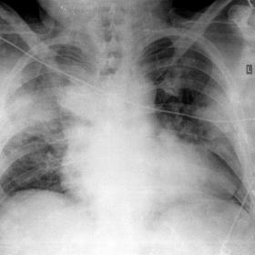 AP chest radiography: bilateral diffuse alveolar pulmonary consolidations, especially in the right upper and middle zones.