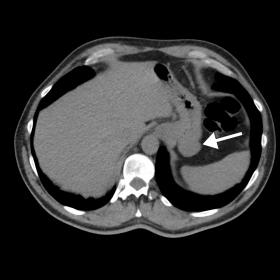 Axial unenhanced CT scan shows a homogeneous mass, apparently exophytic, arising from the posterior wall of the gastric fundu