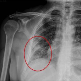 Oblique chest radiography: small ground-glass opacities (circle) in the right lung base not visible on previous imaging studi