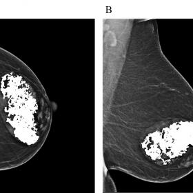 A 45-year-old woman with a palpable painless lump in left breast. (A) A left craniocaudal mammogram shows a 10 cm circumscrib