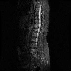 MRI of dorsolomber vertebra on sagittal plane A: STIR, B: T2-w, C: T1-w and D: T1-w with contrast images. Numerous lesions of