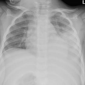CXR at presentation, demonstrating a left middle and lower zone consolidation, with an associated pleural effusion.