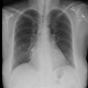 PA chest radiograph demonstrates bilateral pulmonary nodules, largest in right upper zone.