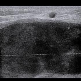Ultrasound image of the left breast