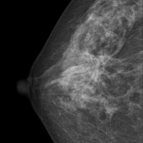 CC view. Heterogeneous dense breasts. An architectural distortion is seen centrally. Moreover, a circumscribed mass with macr