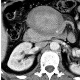 Unenhanced and enhanced CT