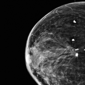 Mammogram demonstrates a 3cm oval well circumscribed mass in the medial right breast with post surgical changes noted in the 