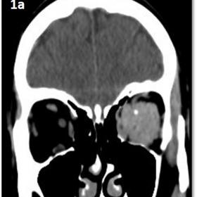 The CT without contrast (Fig. 1a) shows an isoattenuated orbital mass with a punctate calcification. After the administration of contrast the mass has  homogeneous enhancement and we can see the “track tram sign” on axial images (Fig. 1b, arrow). The “dot sign” is shown on coronal images (Fig. 1c). There is no findings in bone window (Fig. 1d).