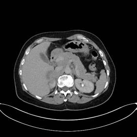 Axial.  Central mass within right kidney, involving right adrenal and directly invading  segment Vlll of the liver. The mass 