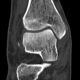 Coronal CT image of the right ankle shows a linear focal density in the soft tissues on the medial side of the medial malleol