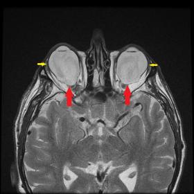 T2-weighted axial MRI showing elongation of the posterior aspects of both orbits (red arrows) as well as slight supero-tempor