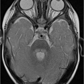 T2-weighted brain MR images
