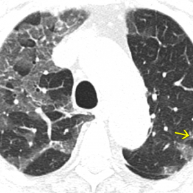 Axial chest CT shows peripheral ground-glass opacities with thickness of interlobular and intra-lobular septa (“crazy pavin