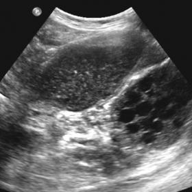 Axial ultrasound image showing a complex lesion at the proximal thigh, consisting of multiple cysts, some of which have echog