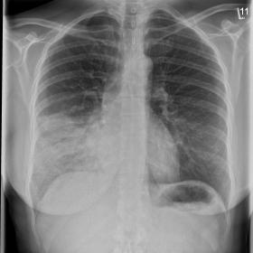 Chest X-ray in a frontal view and b lateral view showing mid lobe consolidation