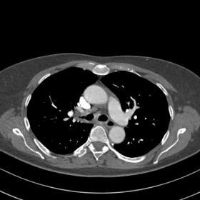CT of the chest, transversal scan. Thicknening of the right main bronchus wall. Lymphadenopathy in front of the carina.