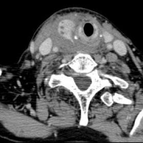 CT scan of the neck and the upper thorax of the patient showing enlarged right thyroid lobe with several minor indistinct hyp