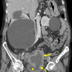 Coronal plane image of contrast-enhanced MDCT. A thickened and dilated loop of small intestine is identified (continuous arro