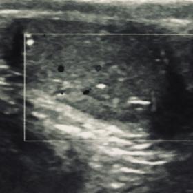 Ultrasonogram of left testis showing testicular microlithiasis and ill defined hypoechoic lesion with minimal internal vascul