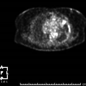 The 18F-FDG PET/ image (figure 1a) shows a small subcutaneous hypercaptation area of the superior internal quadrant of the le