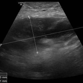 Initial abdominal ultrasound. Heterogeneous subcutaneous fluid collection at the left flank. There was no peritoneal free flu