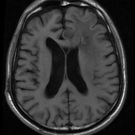 Brain MRI and CT images obtained 4 years before
