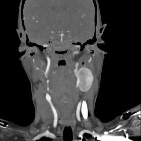 CT angiography neck- coronal view demonstrating a wide neck saccular outpouching arising from the cervical segment of left in