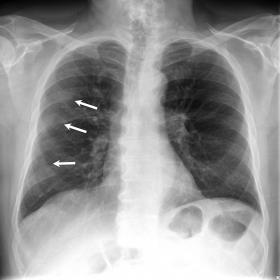 chest x-ray at admission showing patchy ground-glass opacities with peripheral distribution in right lung (arrows).