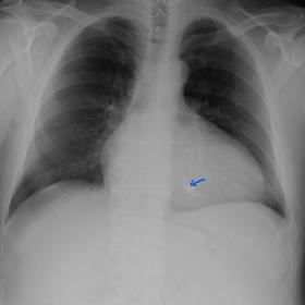 Frontal view of chest x-ray showing moderate cardiomegaly with biventricular preponderance. Ring-like calcific opacity is not