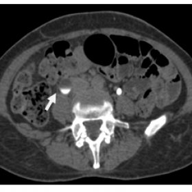 Axial contrast enhanced CT (64- slice) of abdomen in the delayed phase demonstrates the dilated right ureter (arrow).
