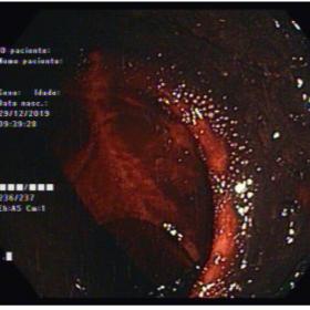 Colonoscopy showing abundant blood inside the colon.