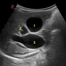 Transabdominal Ultrasound showing common bile duct dilation (CBD). 1, Gallbladder; 2, Cystic duct; 3, CBD cyst