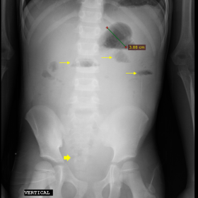 X-ray of the abdomen with a small bowel dilation of 3.8 cm, hydro-aerial levels (thin arrows) and absence of distal gas (thic