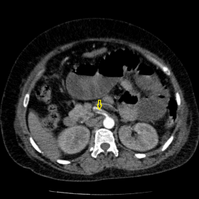 Contrast enhanced CT abdomen showing hypodense filling defect in the proximal superior mesenteric artery suggestive of thromb