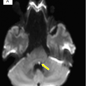 Magnetic resonance imaging diffusion-weighted image (A) and apparent diffusion coefficient map (B)  shows a punctate focus of