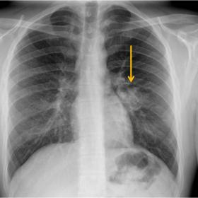 PA (a) and lateral (b) chest radiograph evidenced a consolidation (arrow) in the posterior region of the left lower lobe.