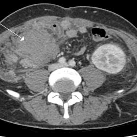 Abdominal CT shows a large mesenteric mass in the ileo-caeco-appendicular region (arrow).