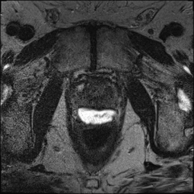 Axial transverse (A), sagittal (B) and coronal (C) images from high-resolution dedicated prostate MRI examination, which was 