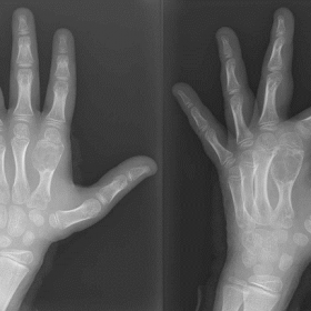 Emergency left hand X-ray. It shows a mostly lithic metaphyseal-diaphyseal bone lesion in the second metacarpal bone, with co