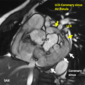 ECG gated white blood short axis view in the atrio-ventricular level showing the dilated LCx and coronary sinus with fistulou